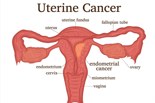 Image depicting a visual representation of uterine cancer awareness with relevant symbols and information.